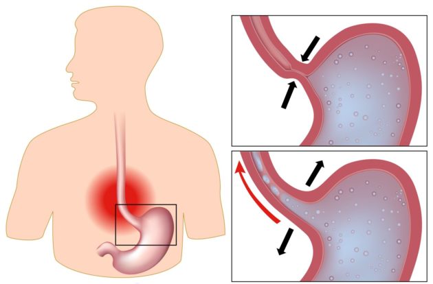 Рефлюкс желудка: причини и методи лечения рефлюксная болезнь желудка